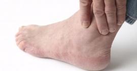 Đau khớp cổ chân là biểu hiện của bệnh gì và có nguy hiểm hay không?