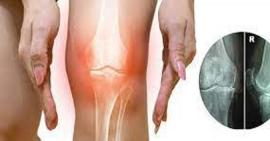 Hẹp khe khớp gối nguy hiểm như thế nào?