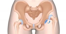 Nguyên nhân và phương pháp điều trị trật khớp háng