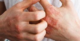 Nguyên nhân, triệu chứng và phương pháp điều trị viêm khớp vảy nến