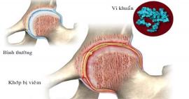 Nguyên nhân và cách điều trị viêm khớp nhiễm khuẩn
