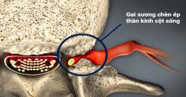 Những nguyên nhân chính khiến cho gai cột sống mọc dài hơn