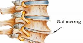 Các triệu chứng của gai cột sống cổ, lưng qua các giai đoạn