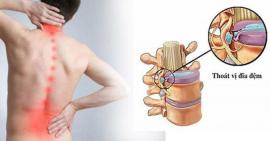 3 phương pháp để giảm thoát vị đĩa đệm thường gặp