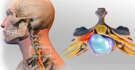 Biểu hiện của thoát vị đĩa đệm cột sống cổ