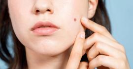 Bật mí bí quyết trị mụn cho từng độ tuổi
