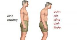 Cần điều trị bệnh viêm cột sống dính khớp sớm để ngăn ngừa tàn phế