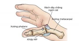 Viêm khớp ngón tay cái có các triệu chứng nào thường gặp?