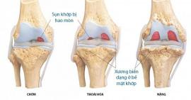 Chăm sóc sụn khớp tốt để quá trình thoái hoá khớp diễn ra chậm hơn