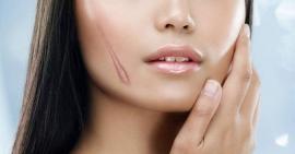 Làm sao để điều trị sẹo đúng cách?