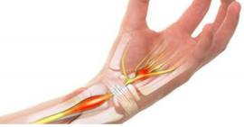 Những nguyên nhân thường gặp dẫn đến đau khớp cổ tay