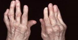 Viêm khớp dạng thấp có những biến chứng gì nguy hiểm hay không?