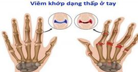 Phân biệt viêm khớp dạng thấp và viêm khớp thông thường để có phương pháp điều trị hiệu quả
