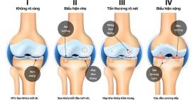 4 giai đoạn chính của bệnh thoái hoá khớp và lưu ý khi điều trị