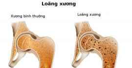 5 ngộ nhận sai lầm về loãng xương khiến bệnh trầm trọng hơn