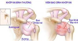 Dấu hiệu nhận biết và cách điều trị viêm dính bao khớp vai
