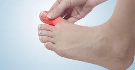 Bệnh Gout cấp tính có những dấu hiệu gì và cách điều trị tại nhà