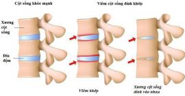 Triệu chứng và cách điều trị viêm cột sống dính khớp