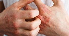 3 thông tin về viêm khớp vảy nến người bệnh nhất định cần phải biết