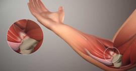 Đừng nên xem thường những cơn đau khớp khuỷu tay