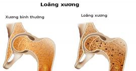 Vấn đề loãng xương và cách điều trị đúng cách