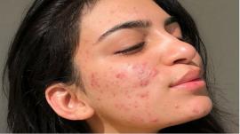 5 hiểu lầm về làn da dầu mụn có mà có thể bạn chưa biết