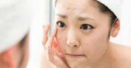 Tuyệt chiêu trị mụn tại nhà cho phái đẹp