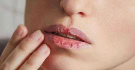 Bật mí những cách chữa trị hiệu quả khi bị dị ứng son môi