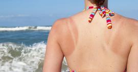 Tất tần tận về da bị cháy nắng và những giải pháp