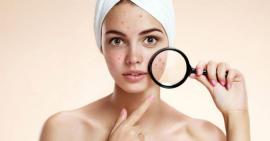Tuyệt chiêu xử lý nhanh gọn làn da nhiều mụn