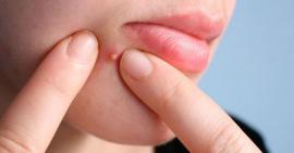 Cần tránh những sai lầm sau đây nếu không muốn làn da bị mụn viêm mãi không khỏi