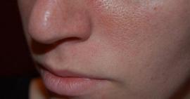 Da có lỗ chân lông to nên chăm sóc thế nào?