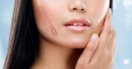 Trị sẹo lồi đơn giản tại nhà chỉ với 5 cách đơn giản