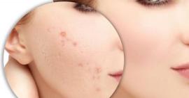 Bật mí cách làm mờ vết thâm do mụn tự nhiên tại nhà