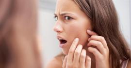 Sau khi nặn mụn nên chăm sóc da như thế nào?