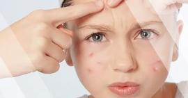8 loại thực phẩm hỗ trợ ngăn ngừa mụn cực kỳ hiệu quả