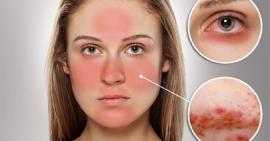 Khám phá mẹo trị mụn cho da nhạy cảm đơn giản và hiệu quả