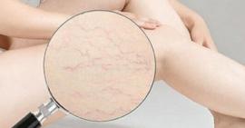 Cải thiện tình trạng rạn da khi tuổi dậy thì, mang thai và sau sinh hiệu quả tại nhà