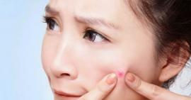 Xoá tan nỗi lo mụn đầu trắng với loạt 8 bí quyết này