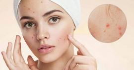 Đang chăm sóc da mụn thì cần tránh những loại thực phẩm sau đây