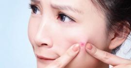 Sau khi nặn mụn nên làm gì để mụn không tái phát?