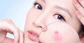 Làm mặt nạ trị thâm mụn tại nhà với 5 cách 