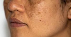 Làm sao để đẩy được chân nám ra ngoài trong điều trị nám da chân sâu?