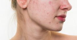 Những lời khuyên của bác sĩ về vấn đề trị mụn