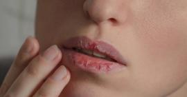 Những dấu hiệu cảnh báo bạn đang thiếu vitamin nghiêm trọng