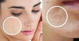 Bí quyết sử dụng nha đam cải thiện tình trạng da bị tróc vảy