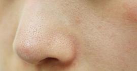 Làm sao để cải thiện tình trạng thâm ở hai bên cánh mũi ở tuổi 30?