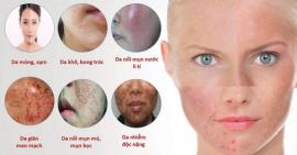 Cách phục hồi làn da bị nhiễm corticoid có thể bạn chưa biết