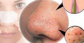 Phân biệt sợi bã nhờn và mụn đầu đen và cách để cải thiện