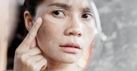Khám phá phương pháp điều trị đồi mồi bằng tỏi an toàn và hiệu quả
